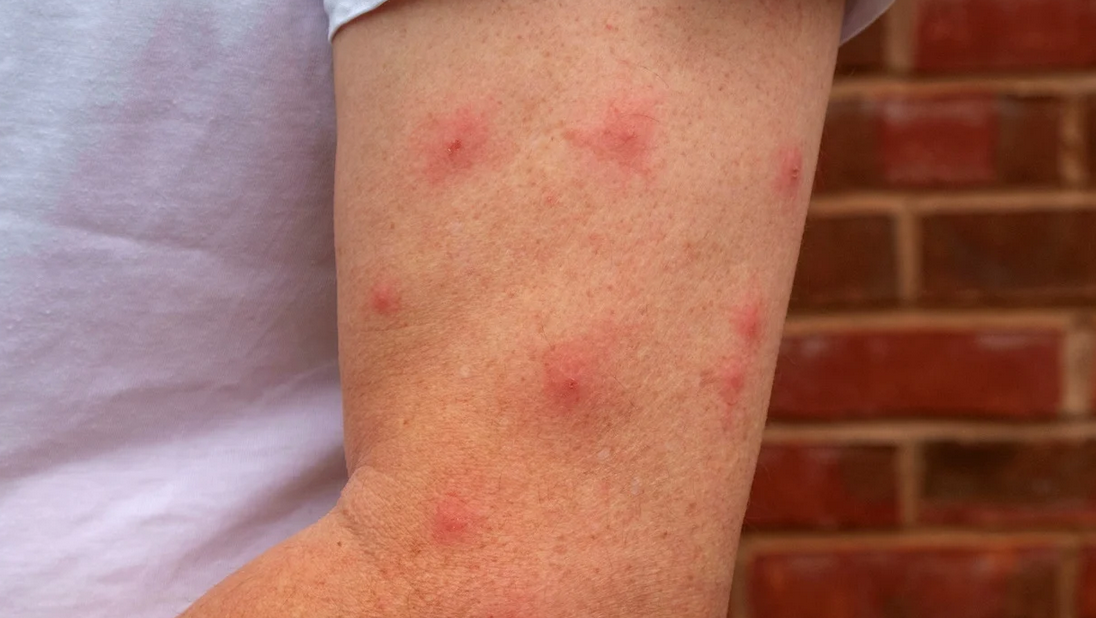 A person's arm with several red, raised bumps and spots, possibly caused by insect bites or an allergic reaction, pictured against a brick wall in Miami-Dade, South Florida.